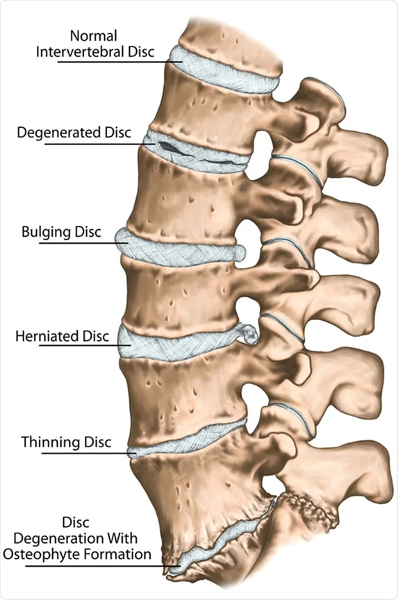 A graphical image of patient spine that shows a normal intervertebral disc compared to degenerated disc, bulging disc, herniated disc, thinning disc and a disc degeneration with osteophyte formation. A graphical image of patient spine that shows a normal intervertebral disc compared to degenerated disc, bulging disc, herniated disc, thinning disc and a disc degeneration with osteophyte formation.